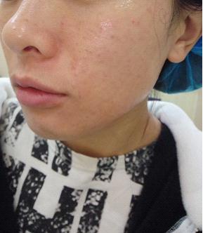 太阳能小野猪水光嫩肤体验(持续更新)