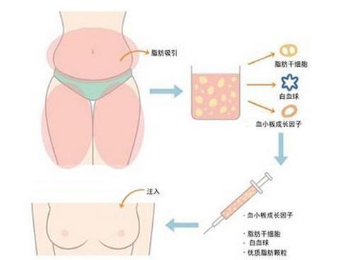 脂肪移植那些事儿:自己的脂肪也有风险