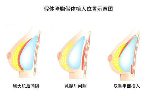 假体丰胸是通过手术将适合患者胸廓类型的假体材料放置在胸部的方法.