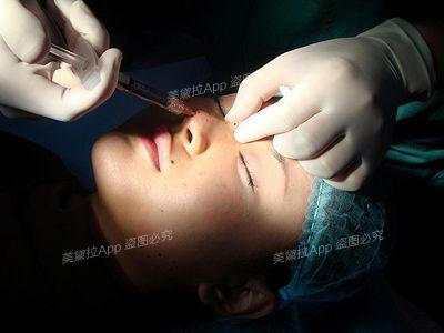 双眼皮割的过宽,半年后就可修复